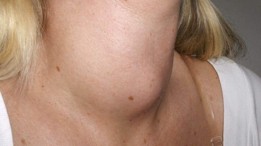 Goiter and Thyroid