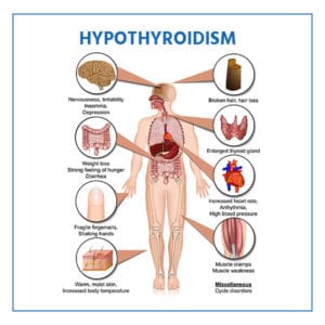 Medication For Hypothyroidism: Tips & Supplements