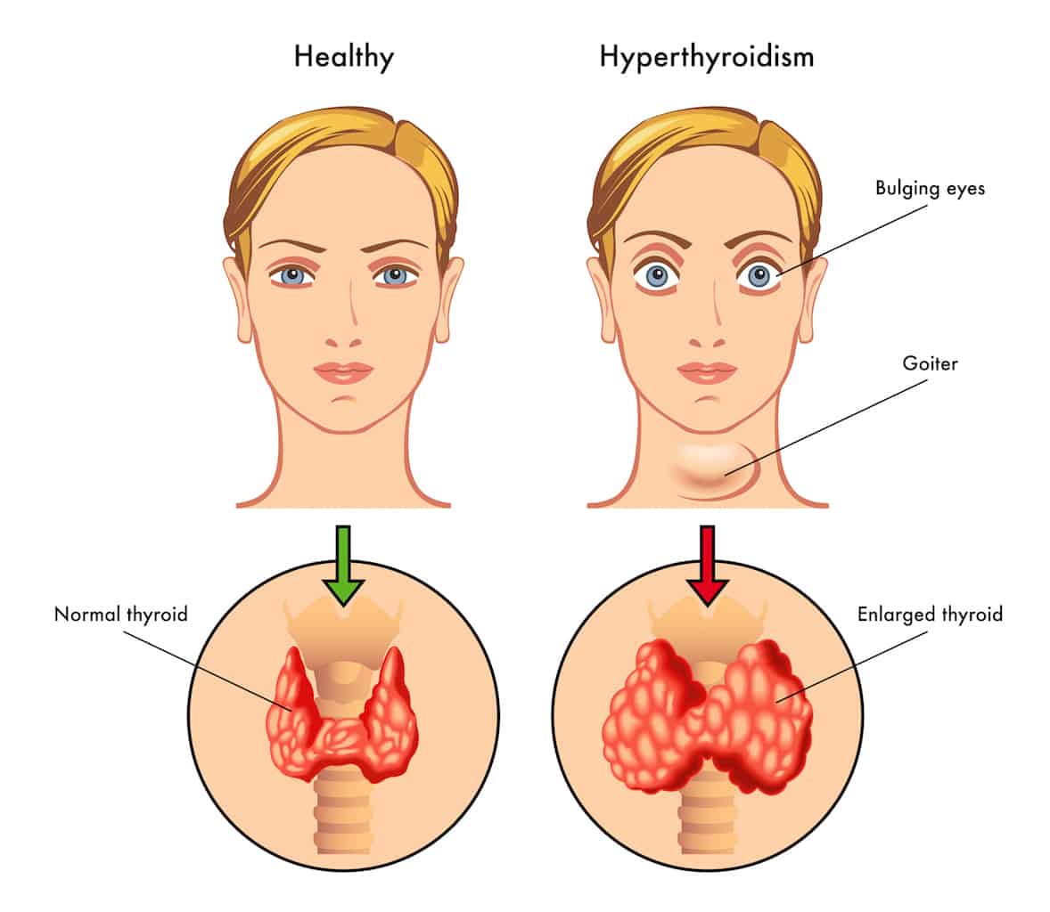 Hyperthyroidisme